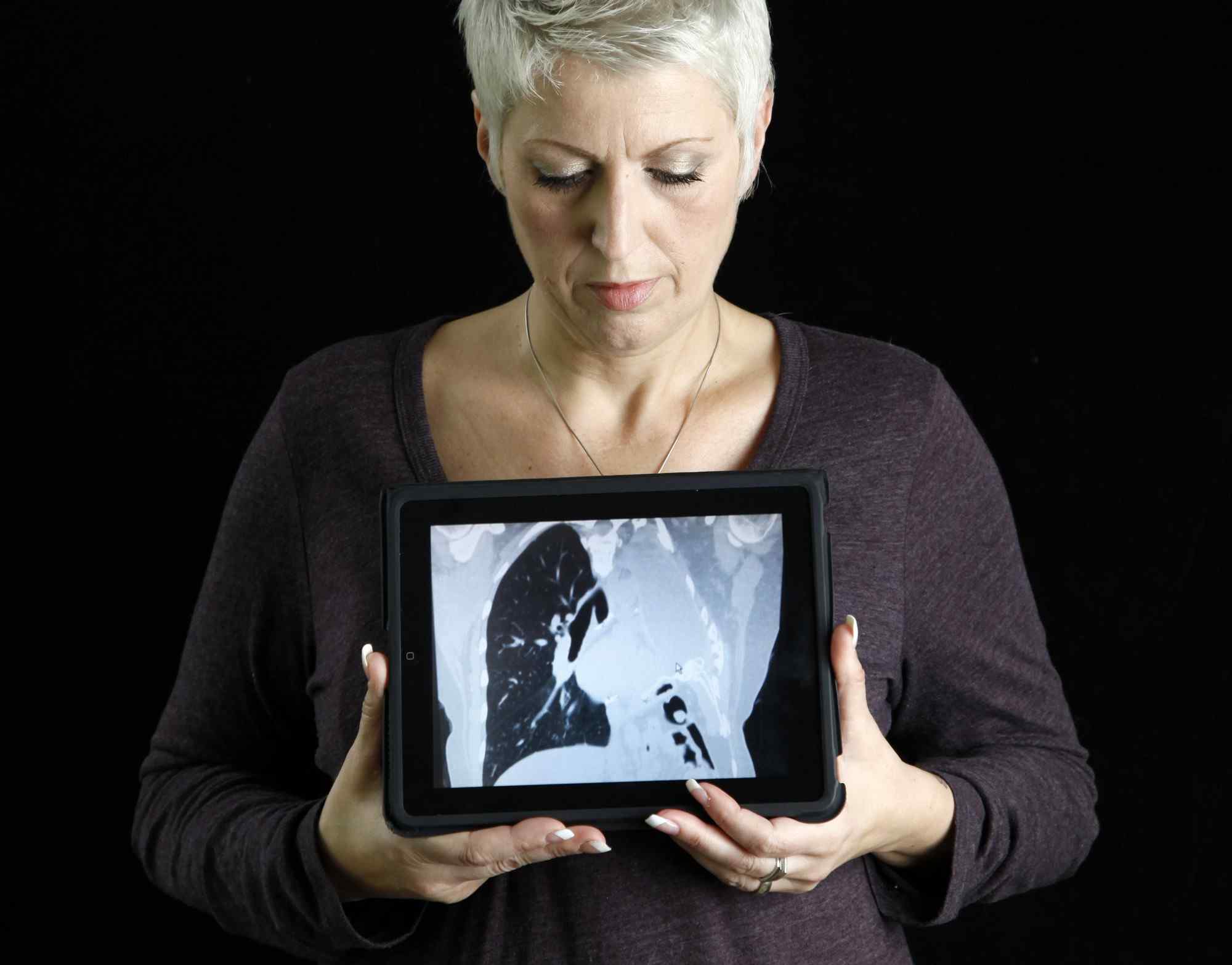 Lung cancer survival rate in England improves Lung cancer survival rate in England improves